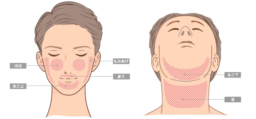メンズミラクリニックのひげ脱毛の部位